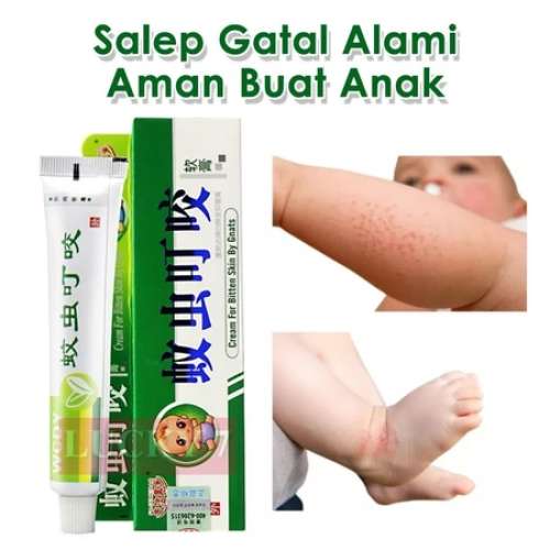Salep Gatal Paling Ampuh Untuk Anak Bayi Digigit Nyamuk Serangga Kudis